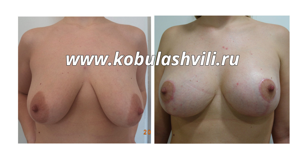 Подтяжка груди после родов. Хирург Тимур Кобулашвили
